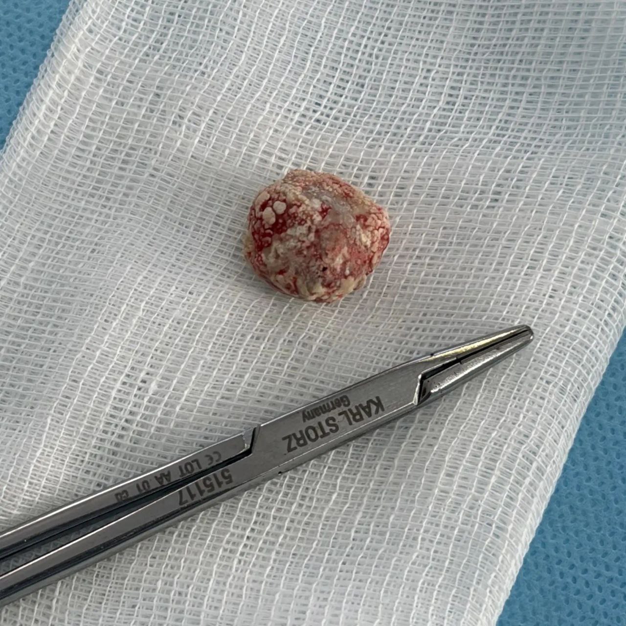 камень в слюнной железе