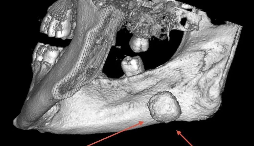 камень в слюнной железе